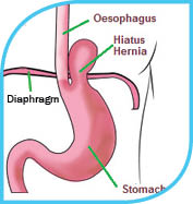 How to handle a hernia